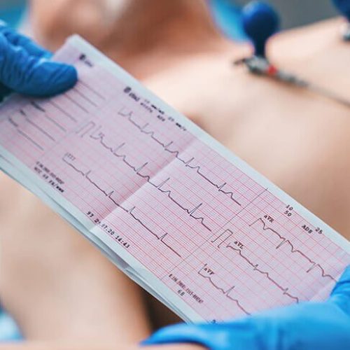 EKG (Electrocardiogram)