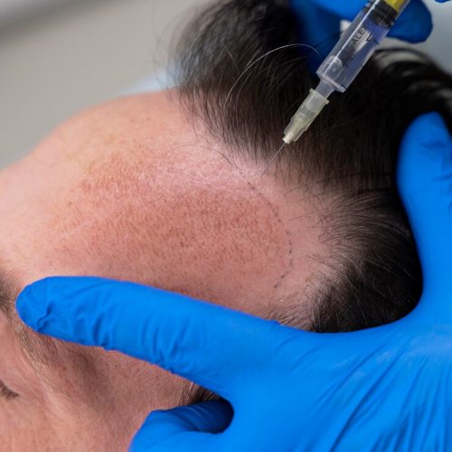 PRP for Hair Loss